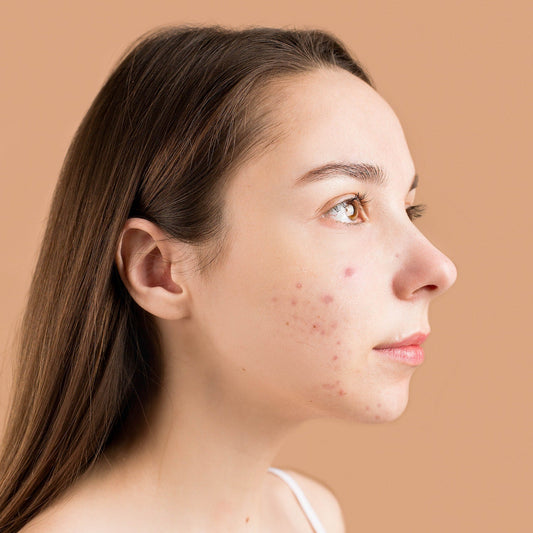 Don't let acne control your life: ways to regain your confidence. - CosIQ