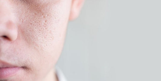 How to get rid of enlarged pores on skin - CosIQ