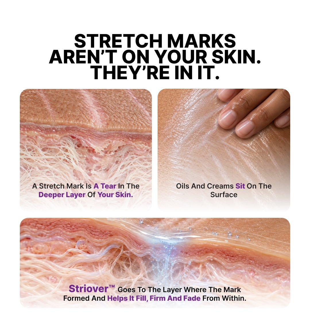 Stretch Mark Removal Roll-On Serum: 3-Month Clear Skin Kit (Pack Of 3 Bottles) - CosIQ