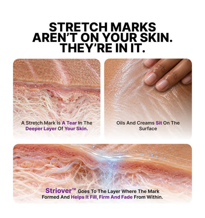 Stretch Mark Removal Roll-On Serum: 3-Month Clear Skin Kit (Pack Of 3 Bottles) - CosIQ