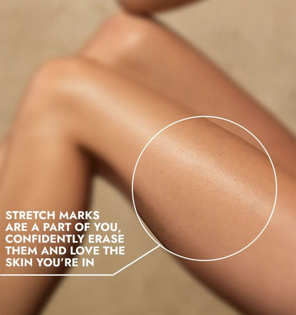 Stretch Mark Removal Roll - On Serum - CosIQ